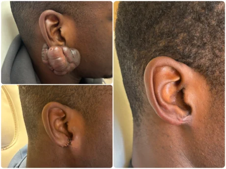 Keloid Removal case #18593