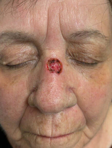 Skin Cancer Reconstruction case #18603