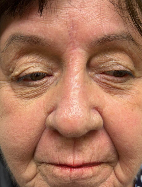 Skin Cancer Reconstruction case #18603