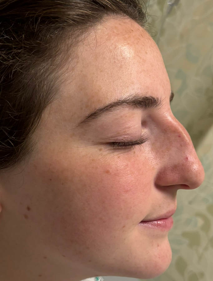 Rhinoplasty case #18897