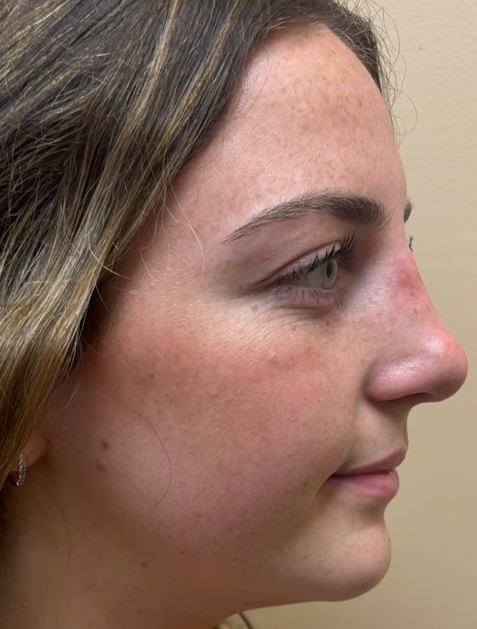 Rhinoplasty case #18897