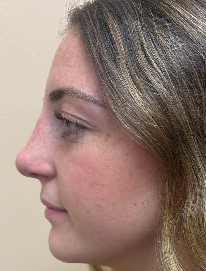 Rhinoplasty case #18897