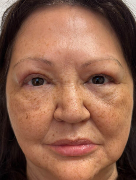 Brow Lift case #18879
