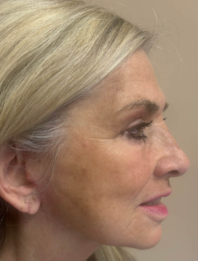 Facelift/Necklift case #18907