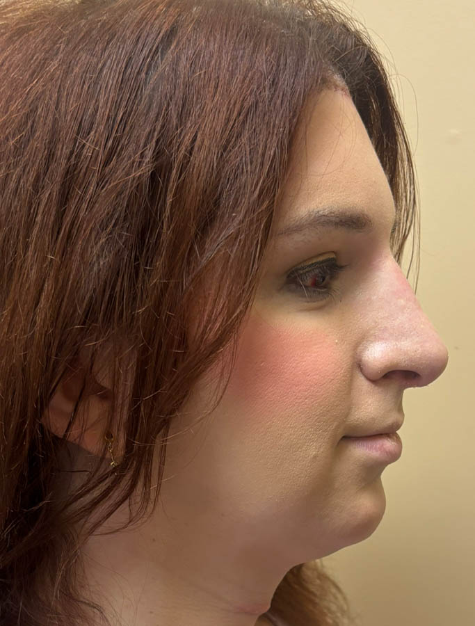 Facial Feminzation case #18917
