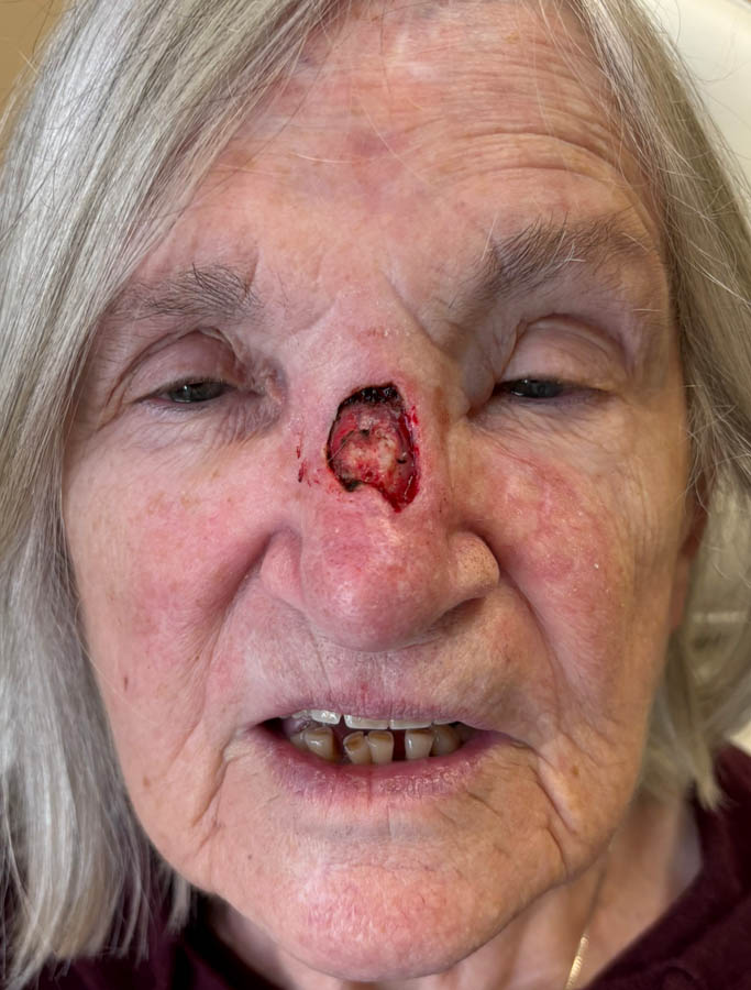 Skin Cancer Reconstruction case #18882