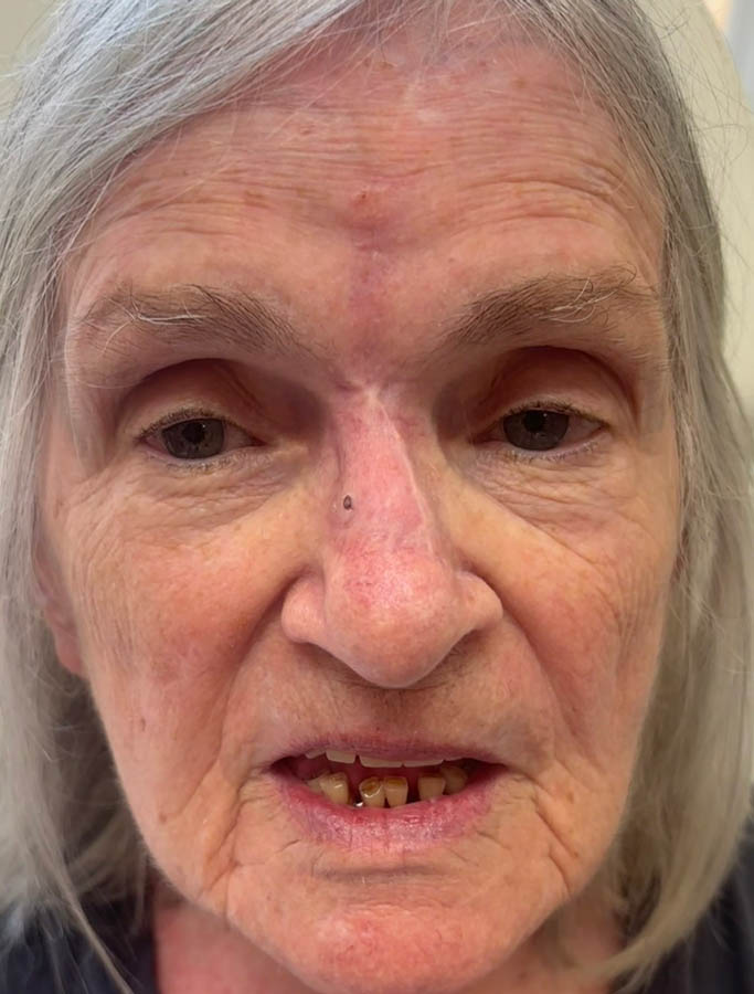 Skin Cancer Reconstruction case #18882