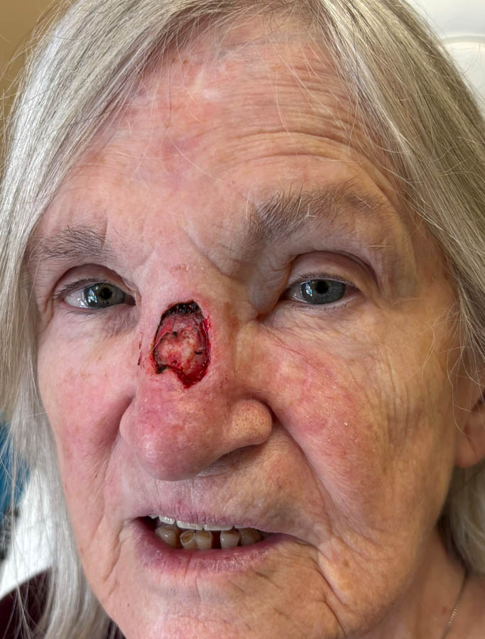 Skin Cancer Reconstruction case #18882