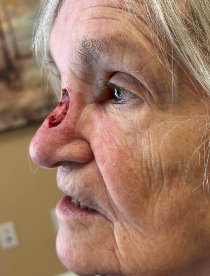Skin Cancer Reconstruction case #18882