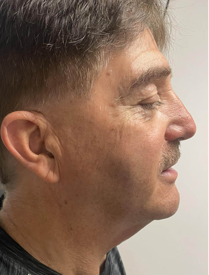 Facelift/Necklift case #18889
