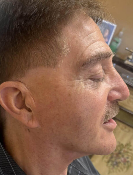 Facelift/Necklift case #18889
