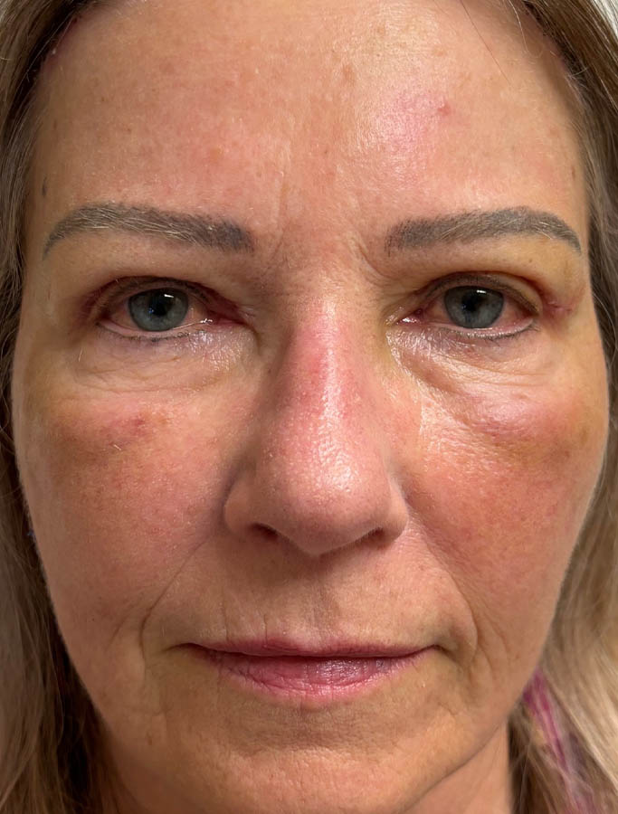 After Image: Patient Case #17823 - front