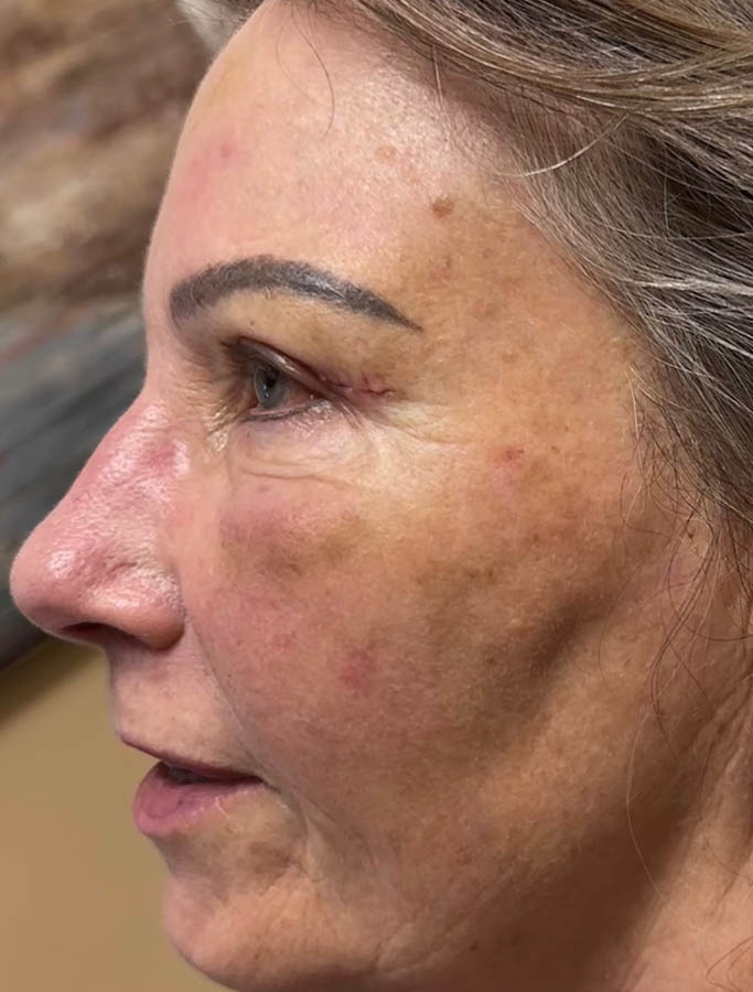 After Image: Patient Case #17823 - left-side