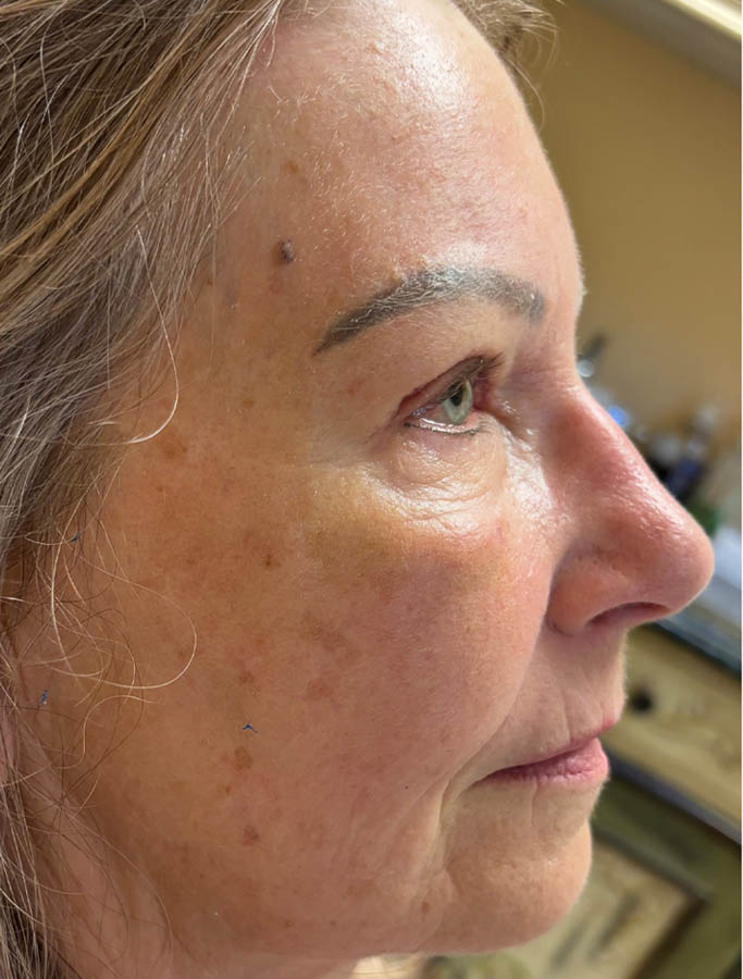 After Image: Patient Case #17823 - right-side