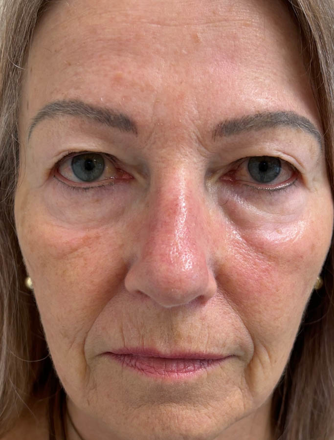 Before Image: Patient Case #17823 - front