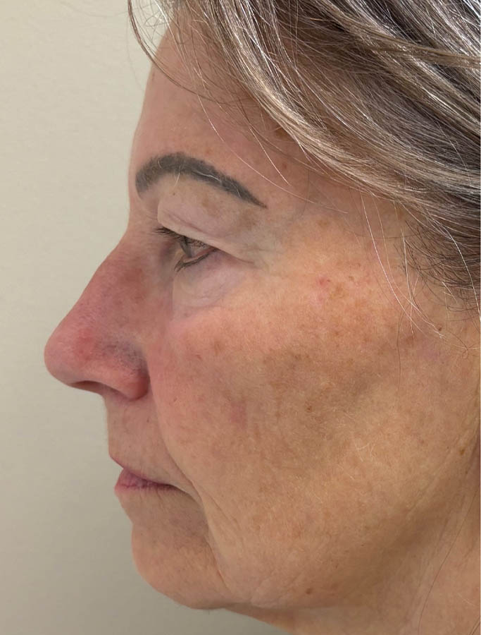 Before Image: Patient Case #17823 - left-side