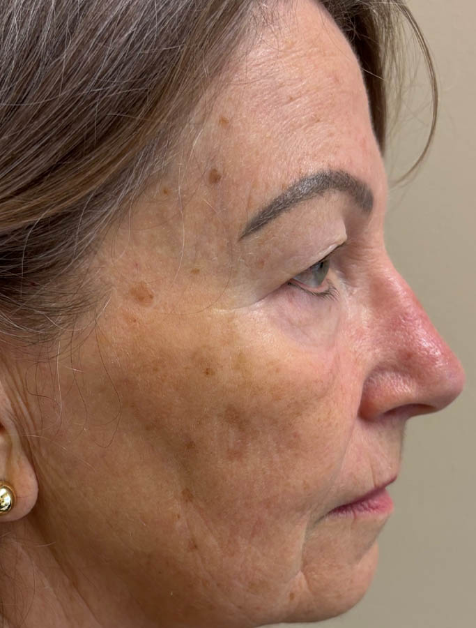 Before Image: Patient Case #17823 - right-side