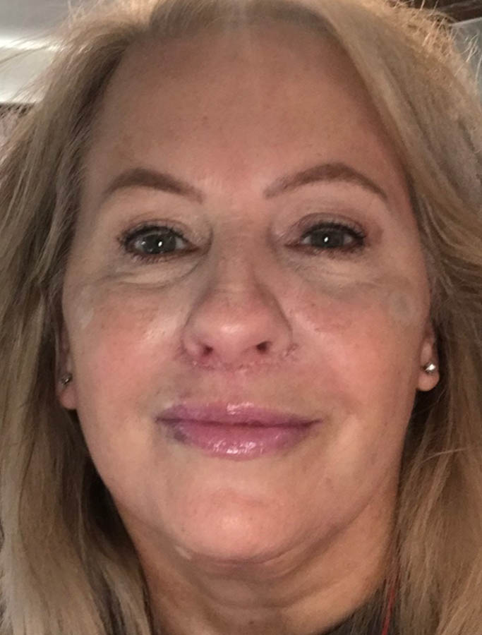 After Image: Patient Case #17830 - front