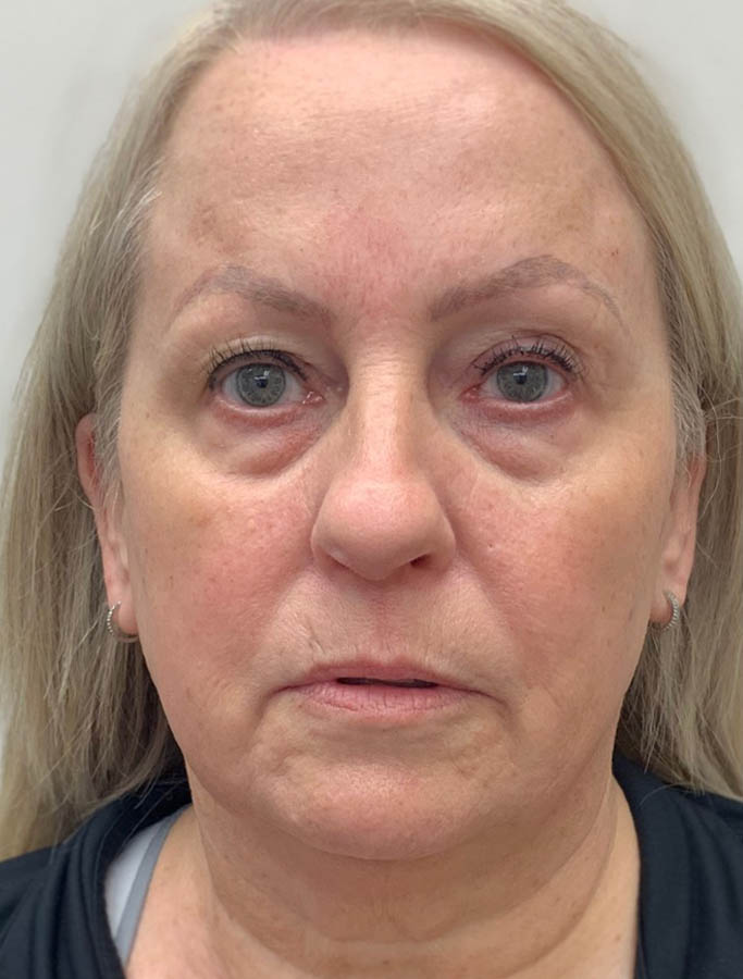 Before Image: Patient Case #17830 - front