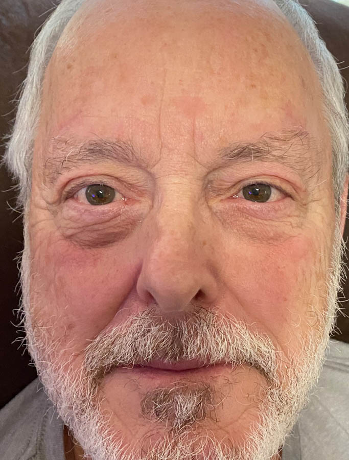 After Image: Patient Case #17834 - front