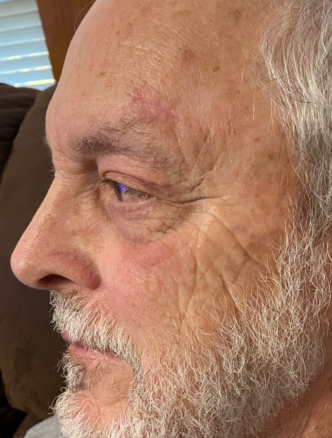 After Image: Patient Case #17834 - left-front-oblique