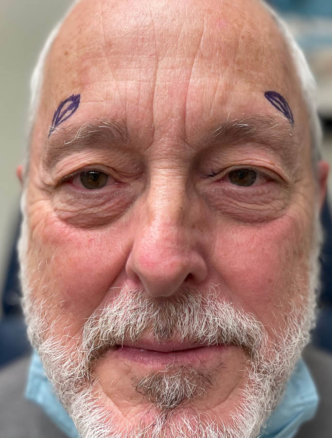 Before Image: Patient Case #17834 - front