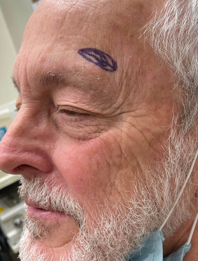 Before Image: Patient Case #17834 - left-front-oblique