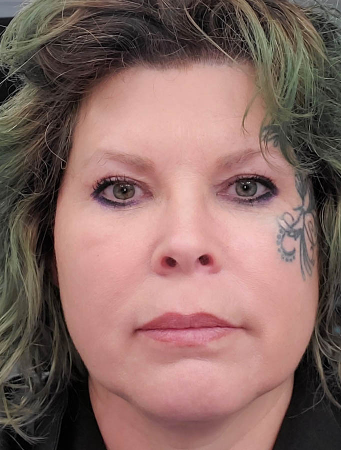 After Image: Patient Case #17841 - front