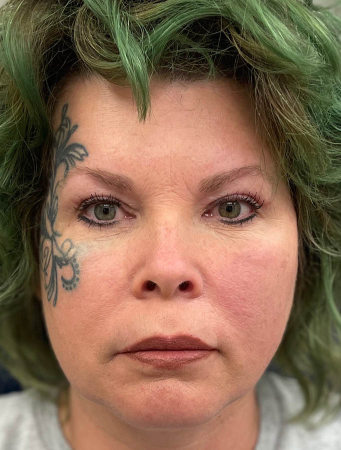 After Image: Patient Case #17841 - front