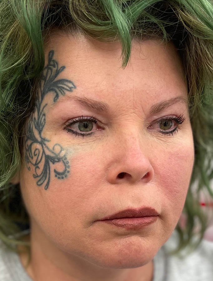 After Image: Patient Case #17841 - right-front-oblique