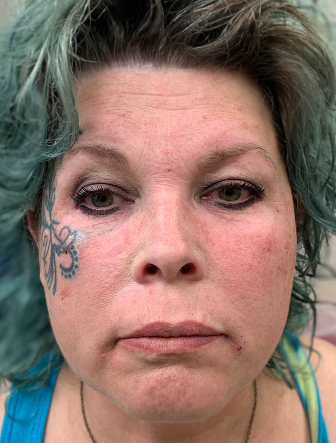 Before Image: Patient Case #17841 - front