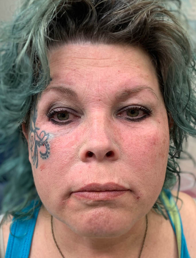 Before Image: Patient Case #17841 - front