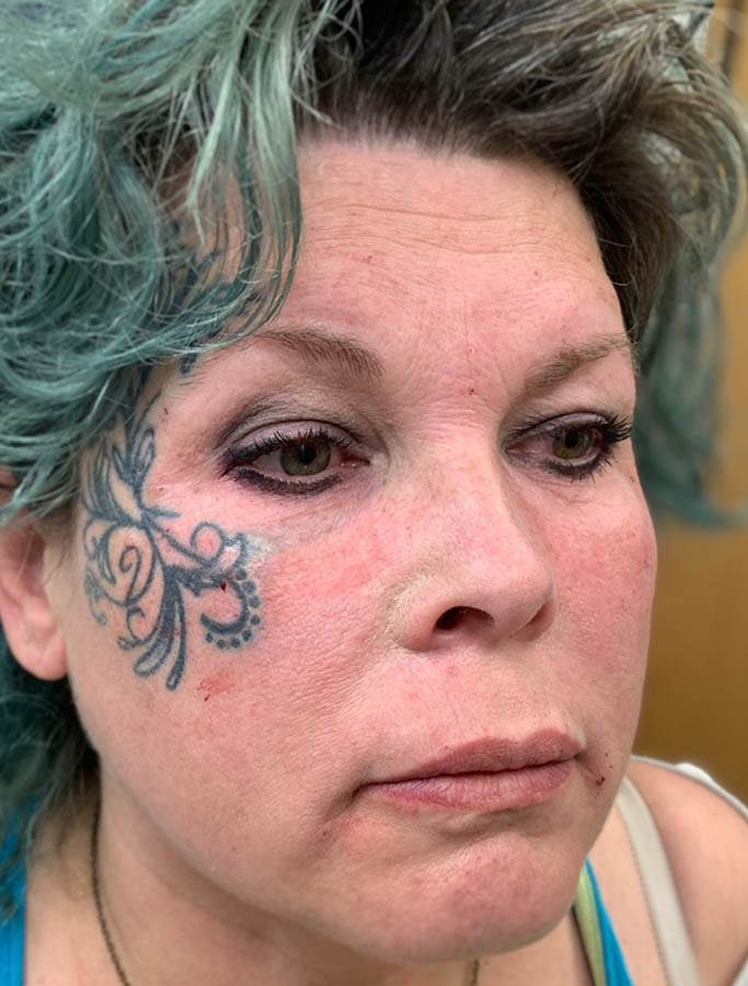 Before Image: Patient Case #17841 - right-front-oblique