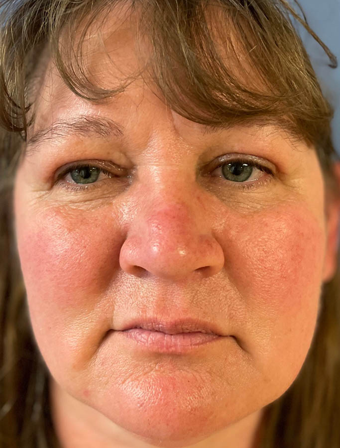 After Image: Patient Case #17852 - front