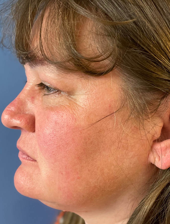 After Image: Patient Case #17852 - left-side