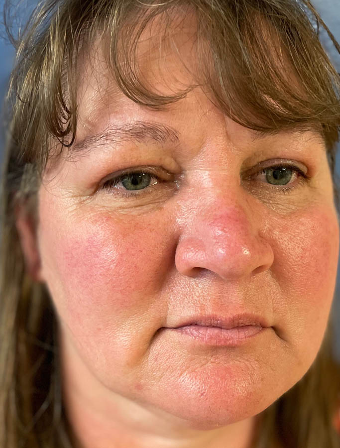 After Image: Patient Case #17852 - right-front-oblique