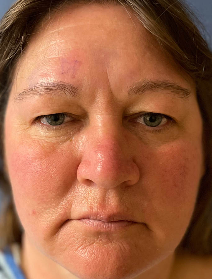 Before Image: Patient Case #17852 - front