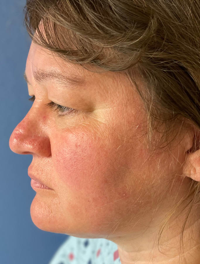 Before Image: Patient Case #17852 - left-side