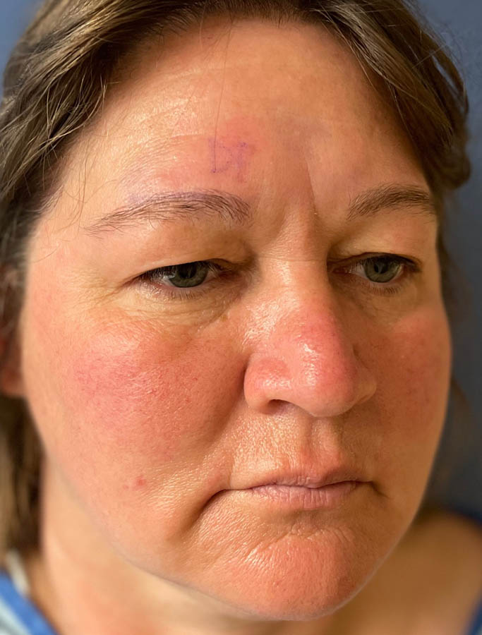 Before Image: Patient Case #17852 - right-front-oblique