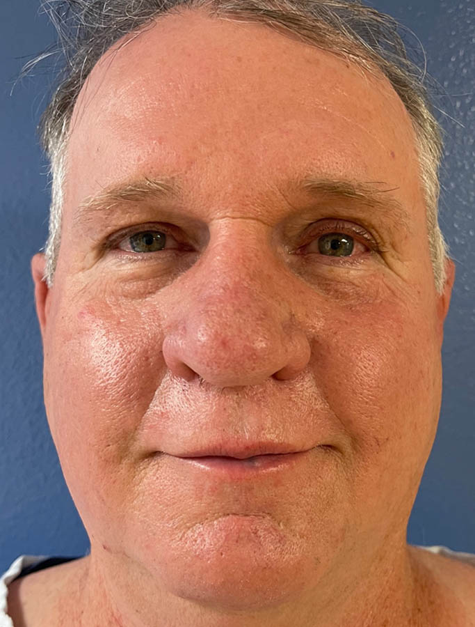 After Image: Patient Case #17863 - front