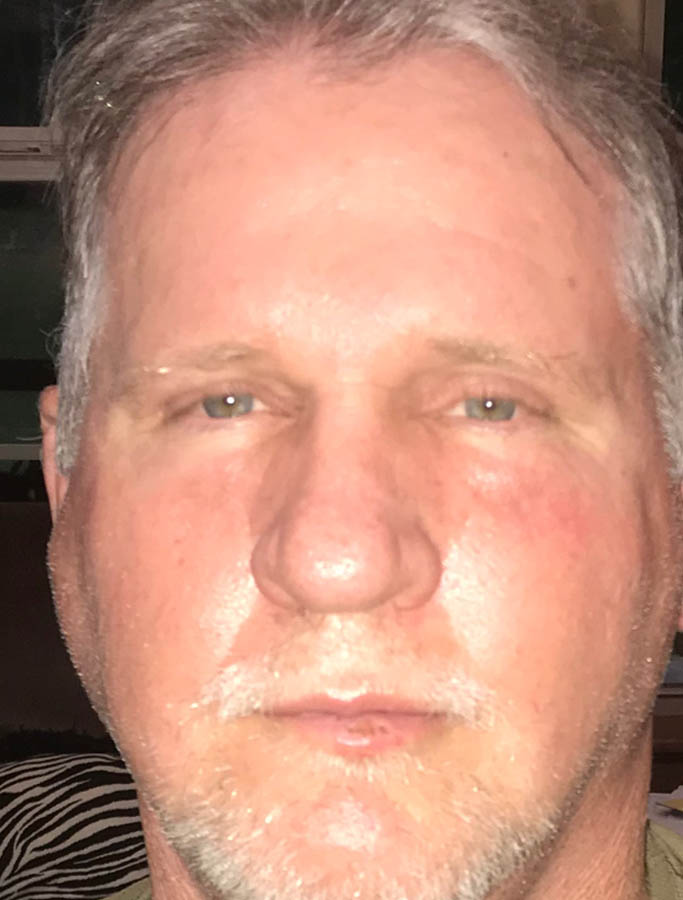 Before Image: Patient Case #17863 - front