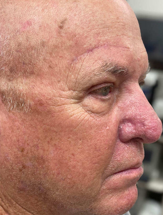 After Image: Patient Case #17866 - right-front-oblique