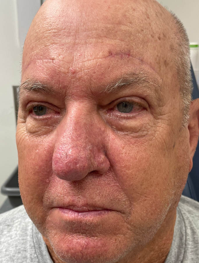 After Image: Patient Case #17866 - left-front-oblique