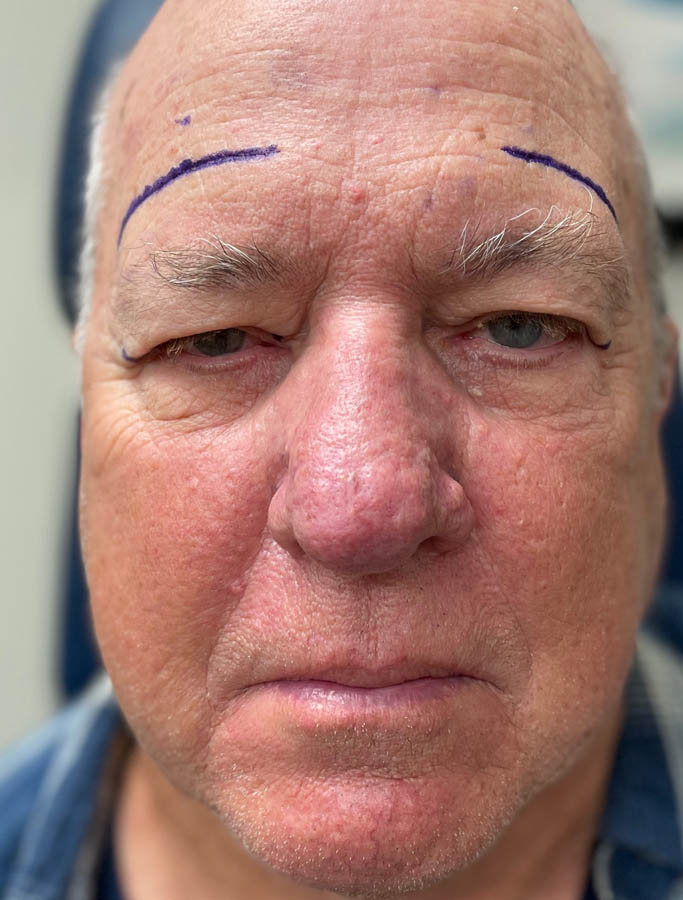 Before Image: Patient Case #17866 - front