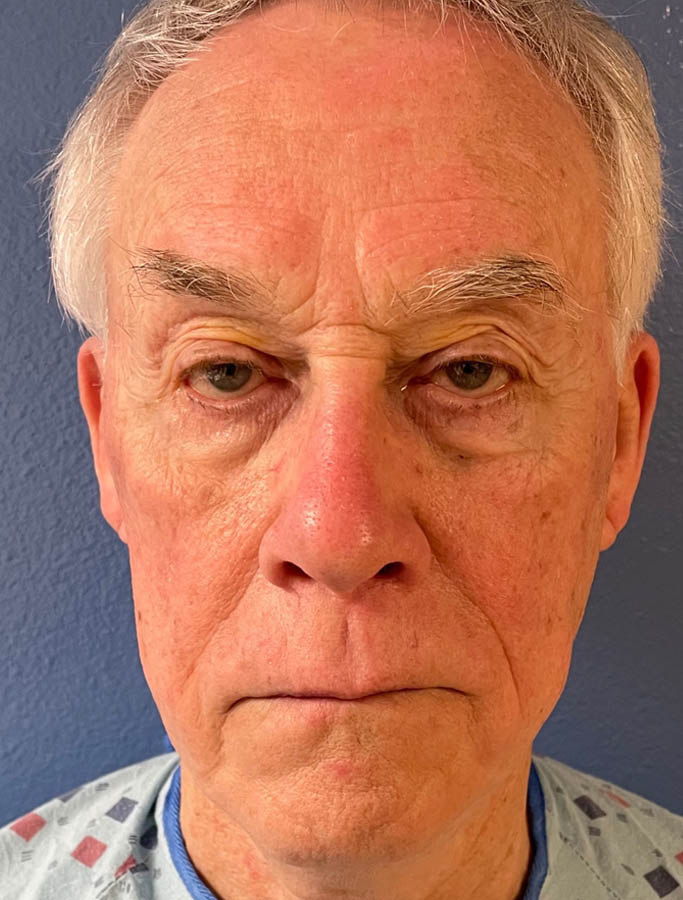 Before Image: Patient Case #17877 - front