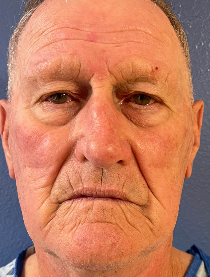 Before Image: Patient Case #17880 - front