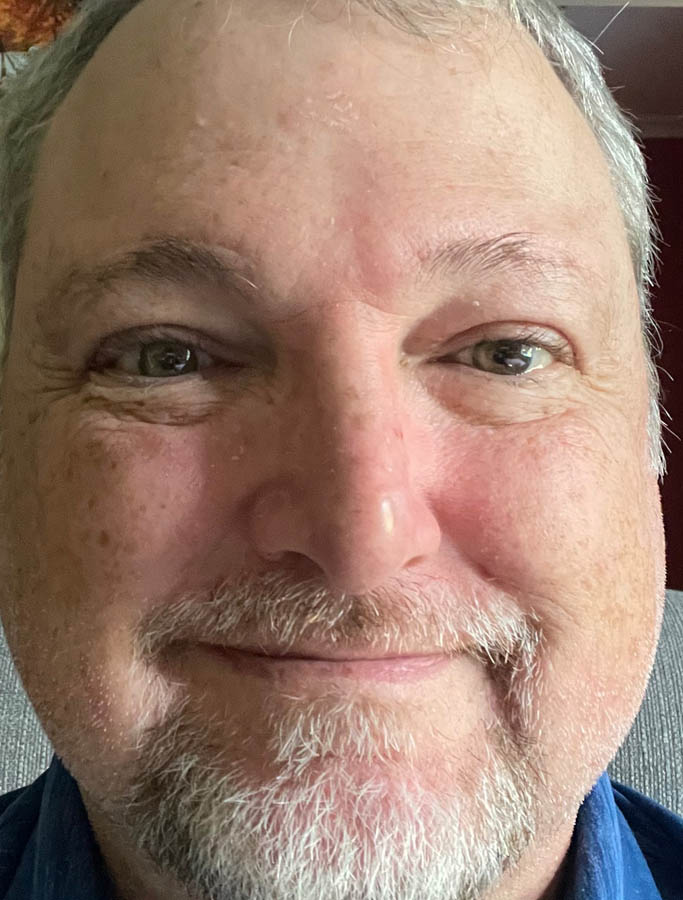 After Image: Patient Case #17886 - front