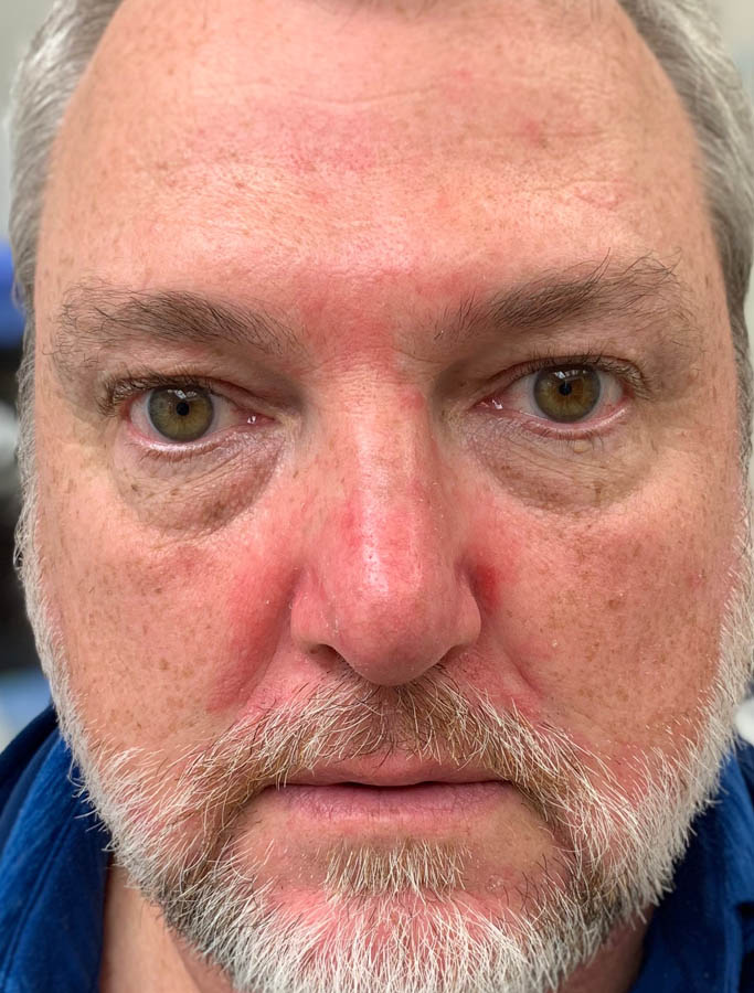 Before Image: Patient Case #17886 - front