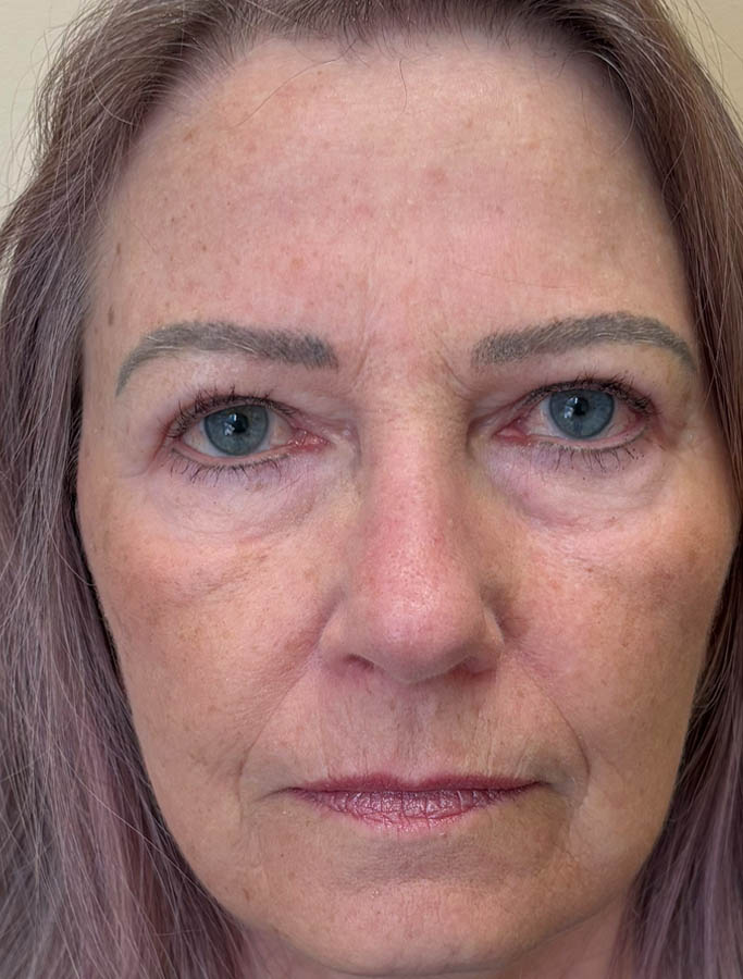 After Image: Patient Case #18609 - front