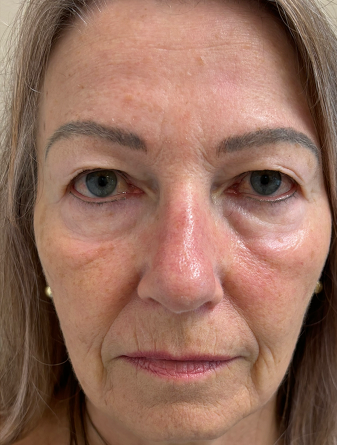 Before Image: Patient Case #18609 - front